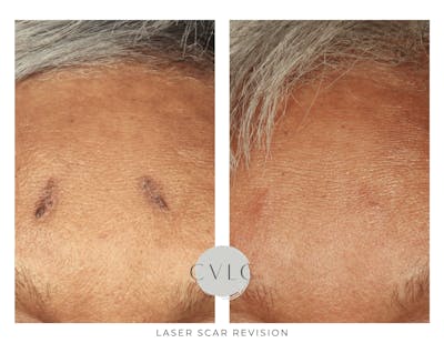 Laser Scar Treatments Before & After Gallery - Patient 149671 - Image 1