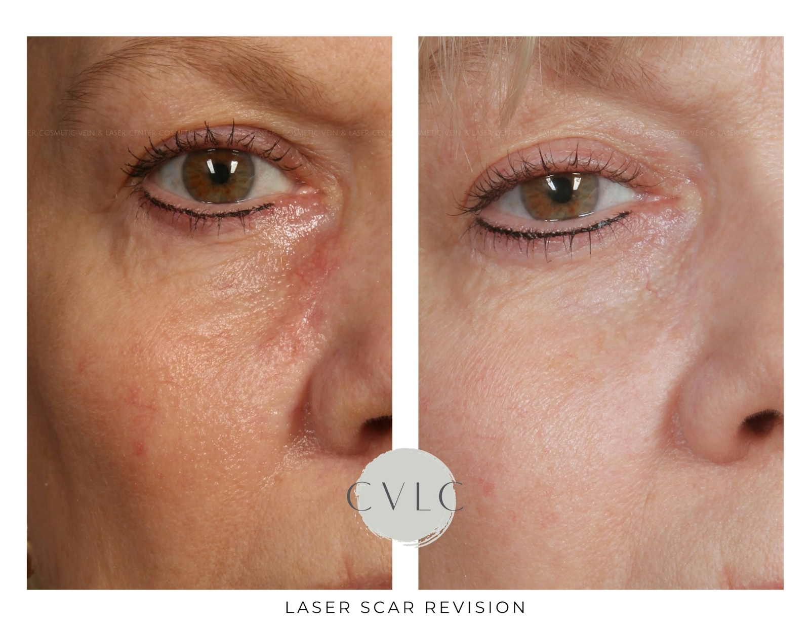 Laser Scar Treatments Before & After Gallery - Patient 343616 - Image 1
