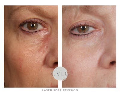 Laser Scar Treatments Before & After Gallery - Patient 343616 - Image 1
