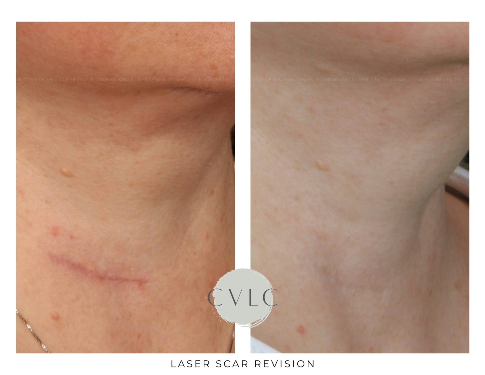 Laser Scar Treatments Before & After Gallery - Patient 421458 - Image 1