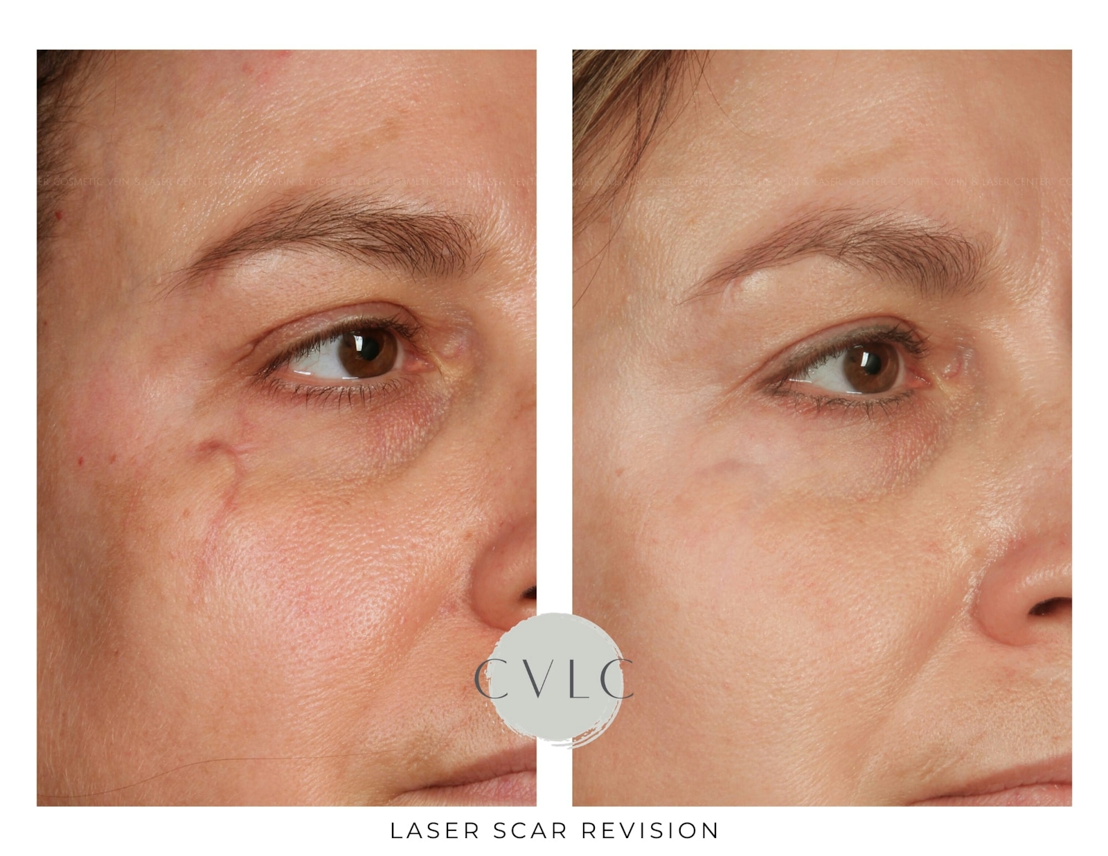 Laser Scar Treatments Before & After Gallery - Patient 386538 - Image 1