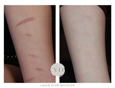 Laser Scar Treatments Before & After Gallery - Patient 809719 - Image 1