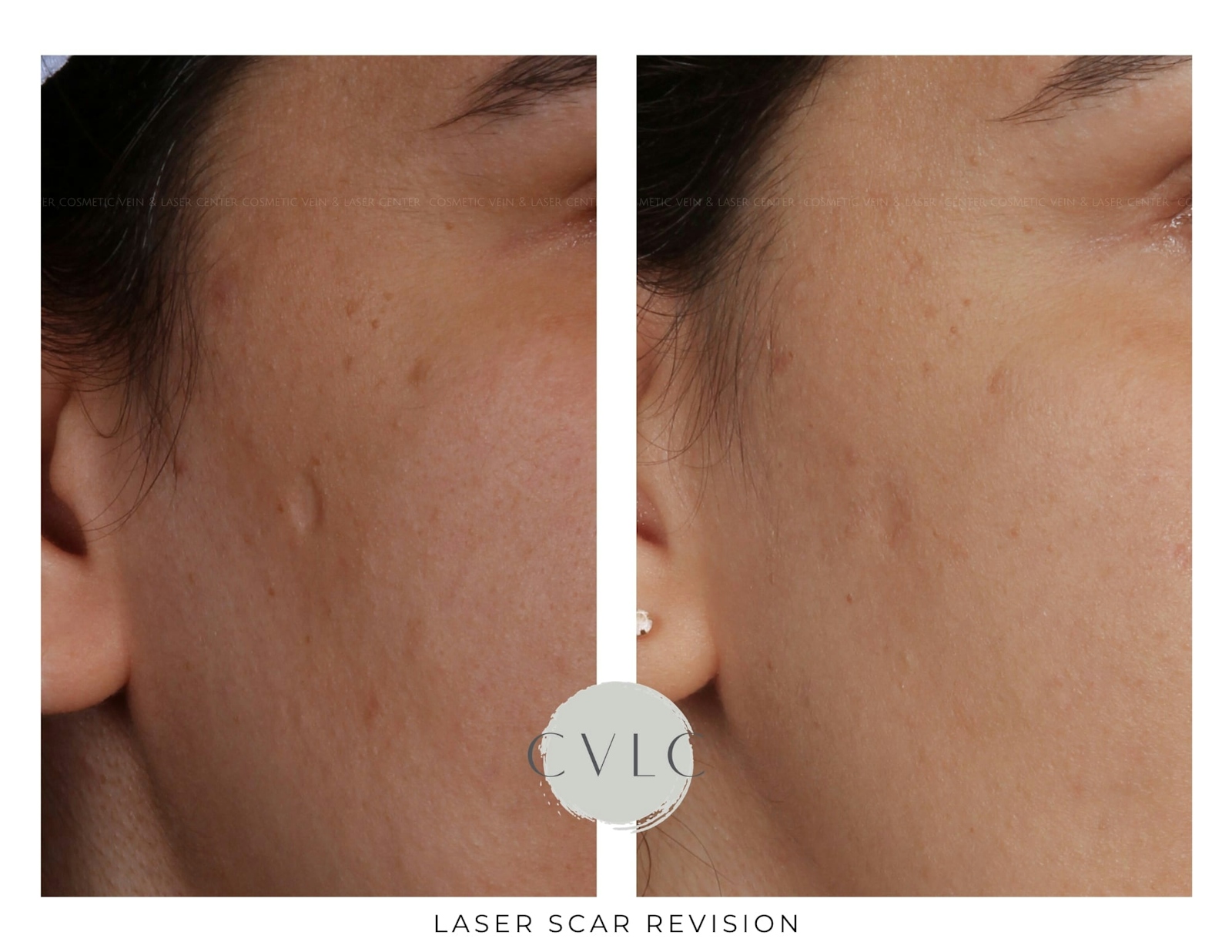 Laser Scar Treatments Before & After Gallery - Patient 364428 - Image 1