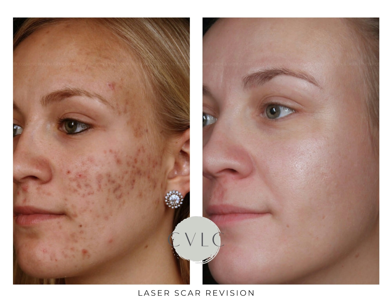 Laser Scar Treatments Before & After Gallery - Patient 132151 - Image 1