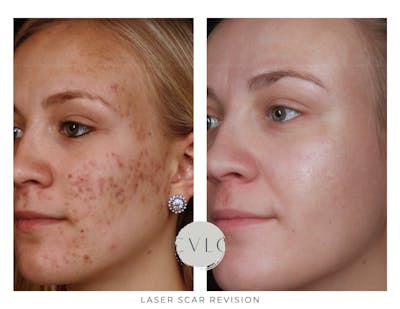 Laser Scar Treatments Before & After Gallery - Patient 132151 - Image 1
