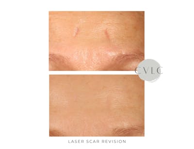 Laser Scar Treatments Before & After Gallery - Patient 117016 - Image 1