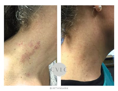 Birthmark and Hemangiomas Laser Treatments Before & After Gallery - Patient 770508 - Image 1