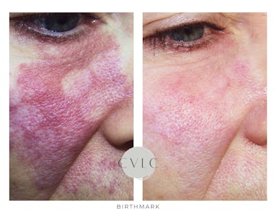 Birthmark and Hemangiomas Laser Treatments Before & After Gallery - Patient 102728 - Image 1