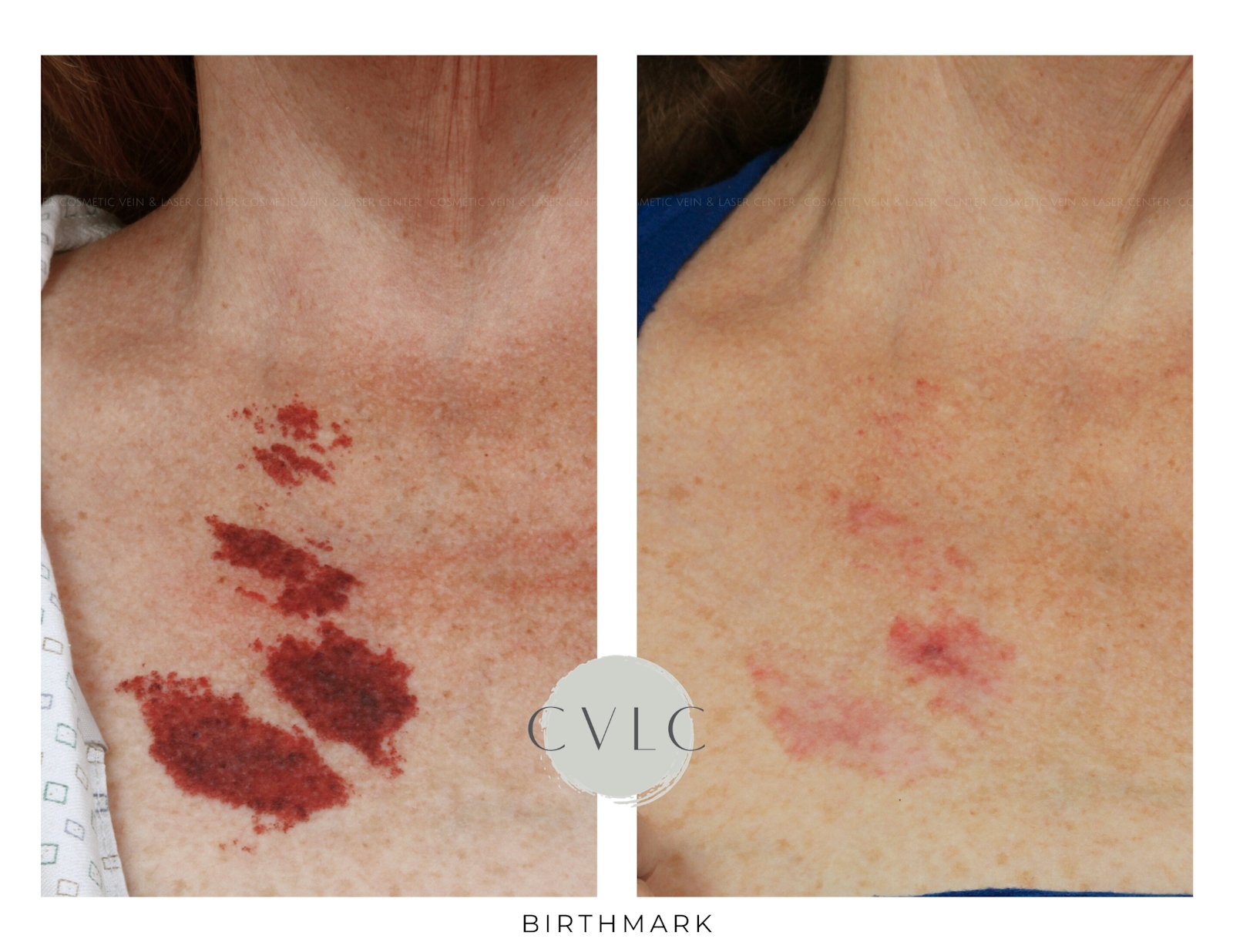 Birthmark and Hemangiomas Laser Treatments Before & After Gallery - Patient 337323 - Image 1
