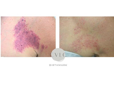 Birthmark and Hemangiomas Laser Treatments Before & After Gallery - Patient 110240 - Image 1