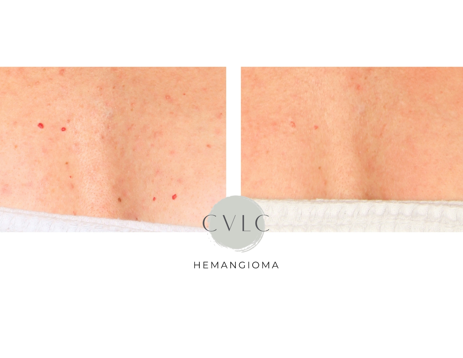 Birthmark and Hemangiomas Laser Treatments Before & After Gallery - Patient 185452 - Image 1