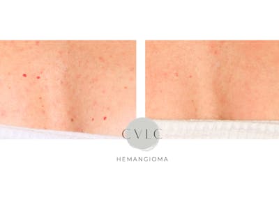 Birthmark and Hemangiomas Laser Treatments Before & After Gallery - Patient 185452 - Image 1
