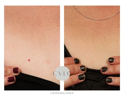 Birthmark and Hemangiomas Laser Treatments Before & After Gallery - Patient 106333 - Image 1