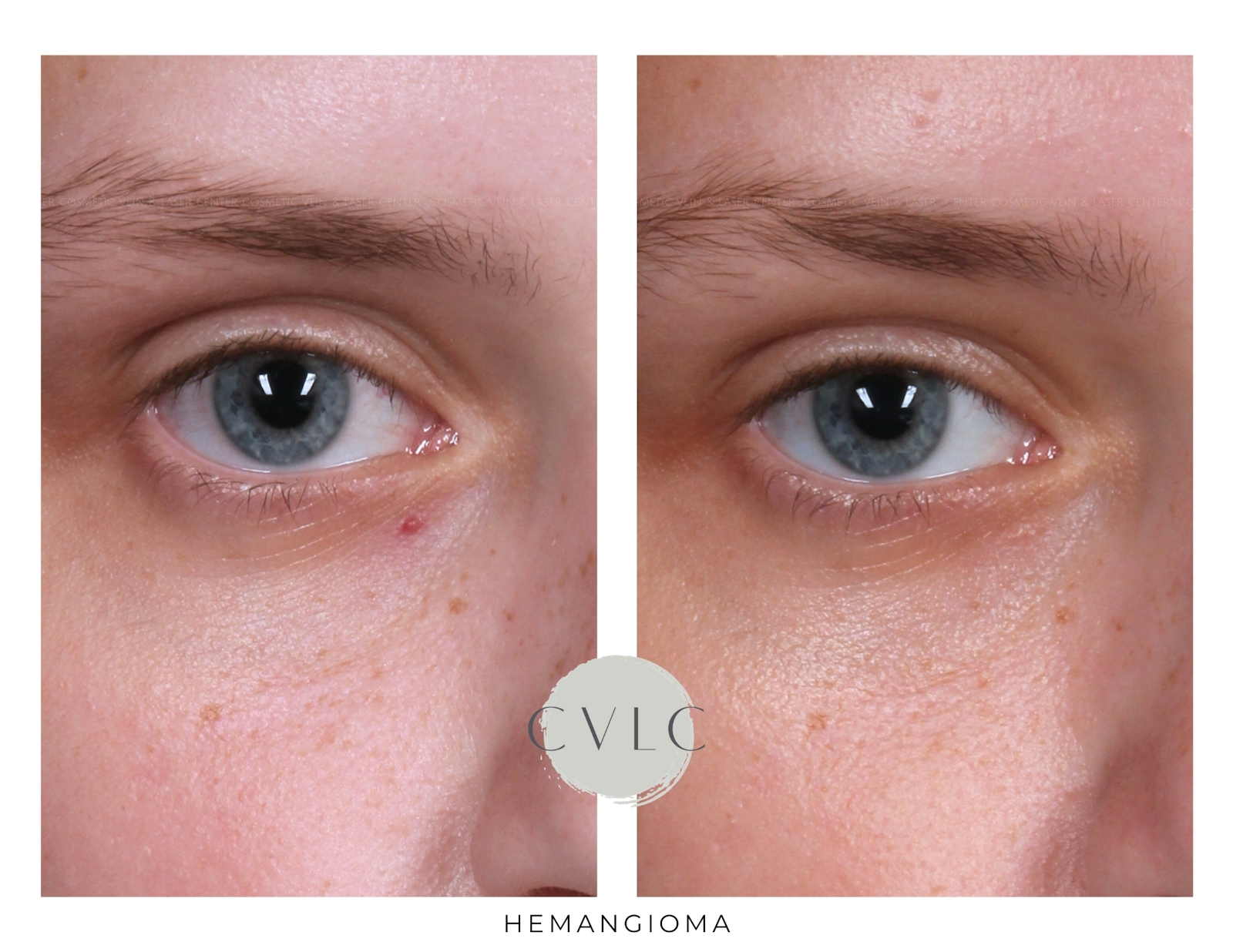 Birthmark and Hemangiomas Laser Treatments Before & After Gallery - Patient 160020 - Image 1