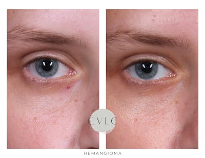 Birthmark and Hemangiomas Laser Treatments Before & After Gallery - Patient 160020 - Image 1