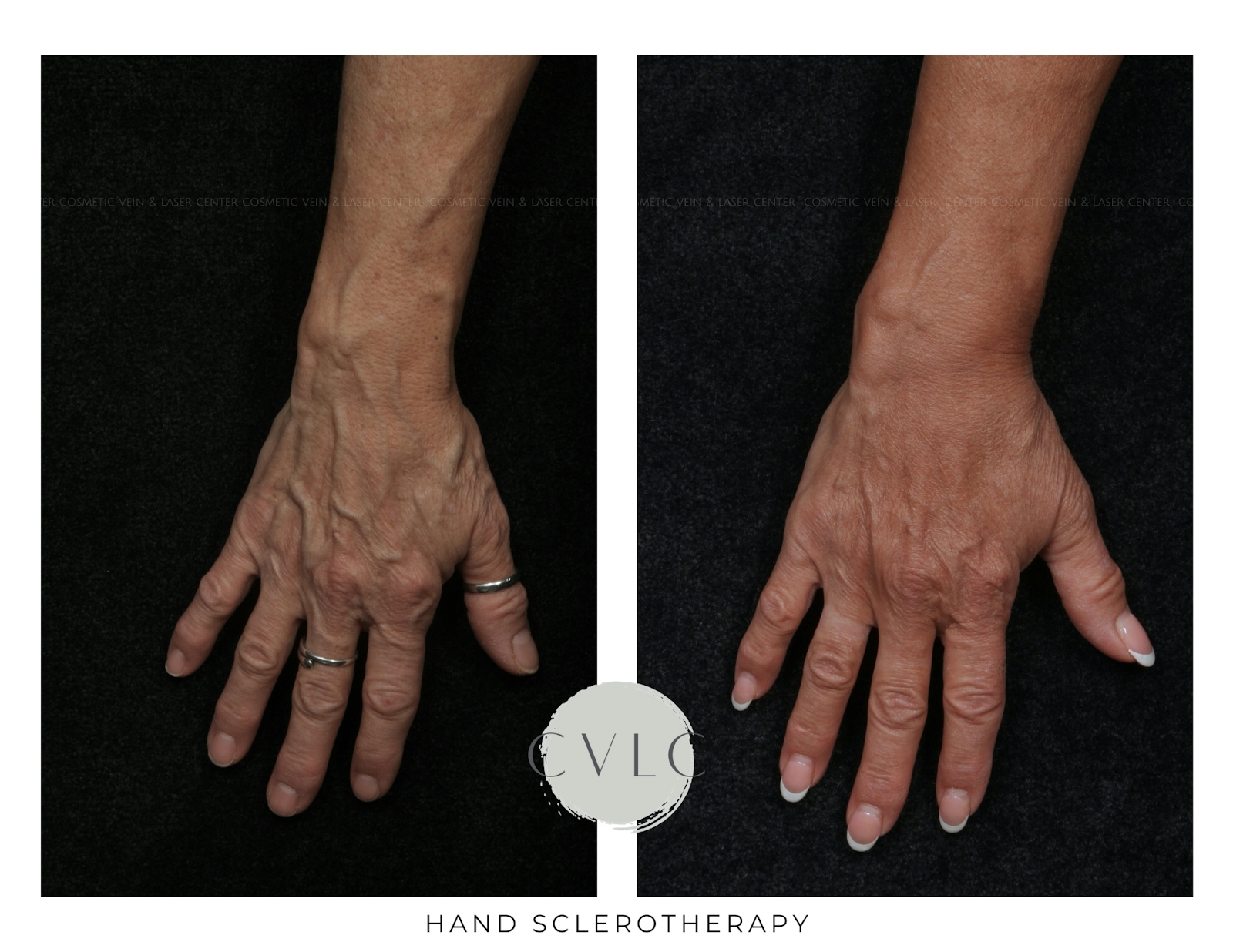 Hand Sclerotherapy Before & After Gallery - Patient 369794 - Image 1