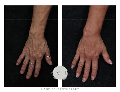 Hand Sclerotherapy Before & After Gallery - Patient 369794 - Image 1