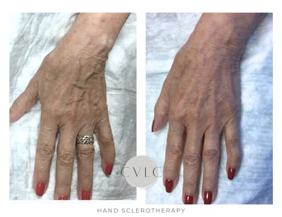 Hand Sclerotherapy Before & After Gallery - Patient 356022 - Image 1