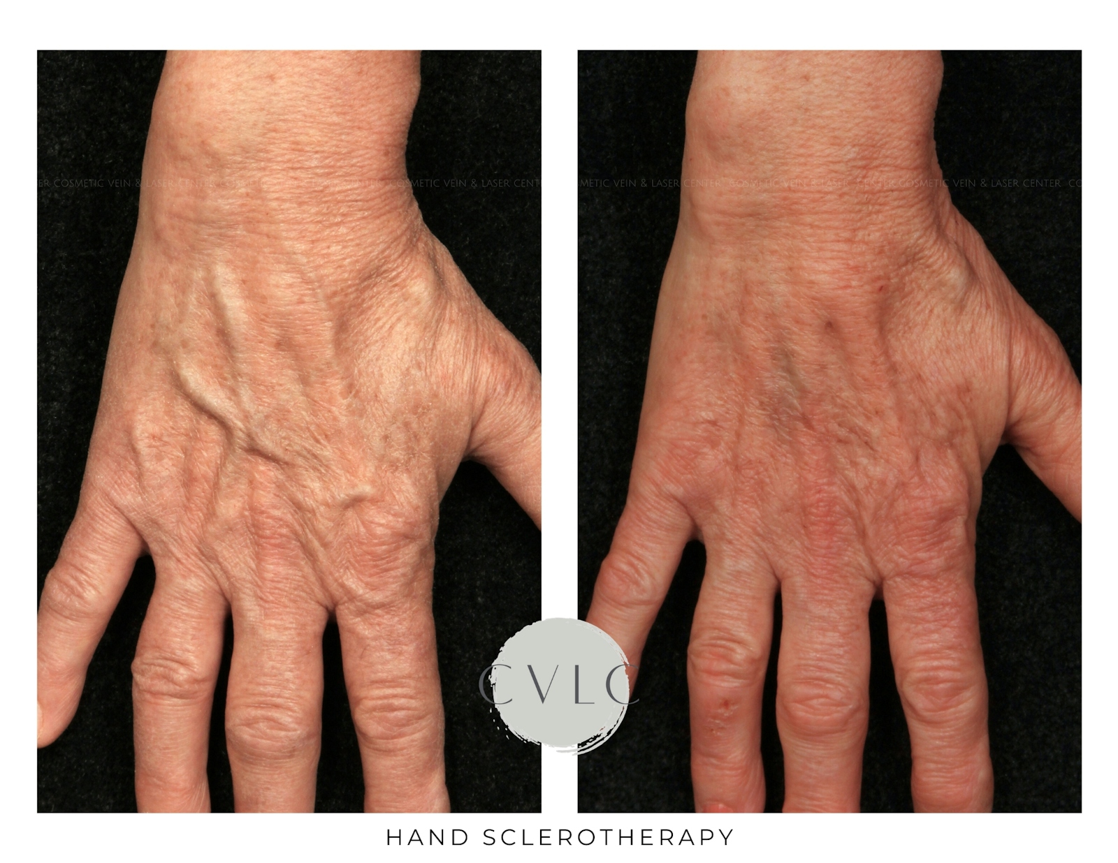 Hand Sclerotherapy Before & After Gallery - Patient 316153 - Image 1