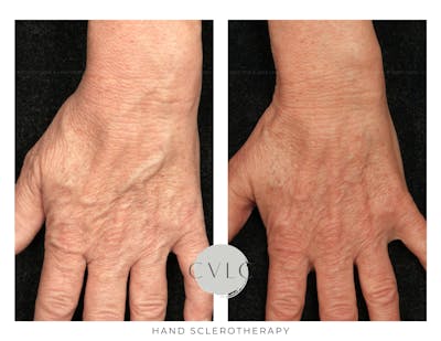 Hand Sclerotherapy Before & After Gallery - Patient 100967 - Image 1
