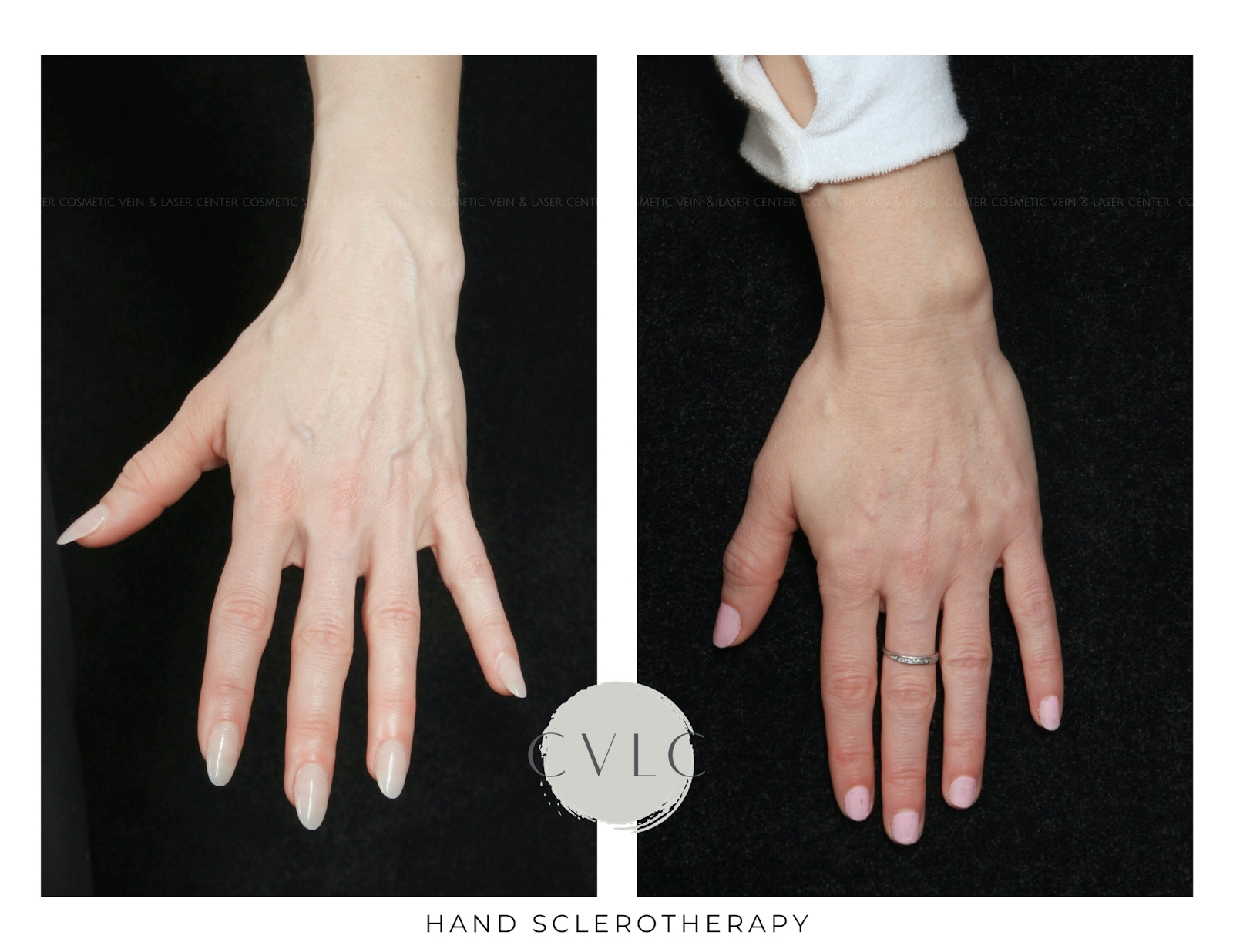 Hand Sclerotherapy Before & After Gallery - Patient 140193 - Image 1