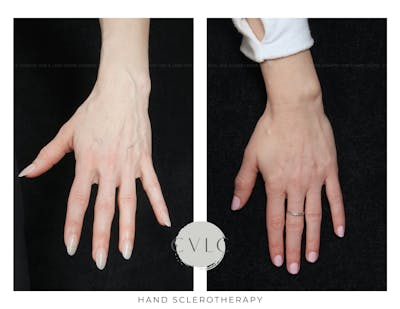 Hand Sclerotherapy Before & After Gallery - Patient 140193 - Image 1