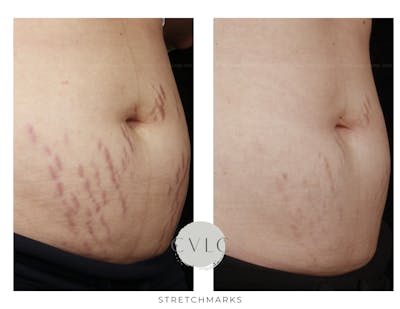 Stretchmarks Before & After Gallery - Patient 185298 - Image 1