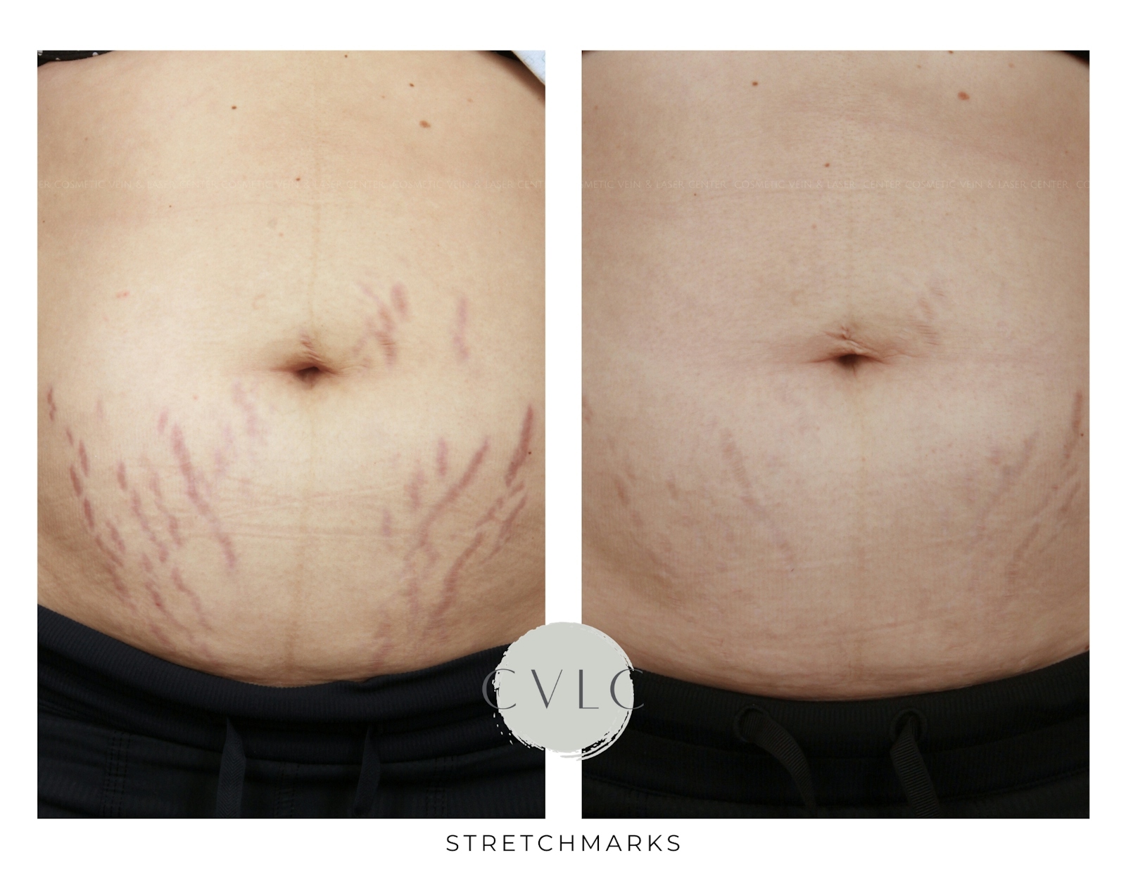 Stretchmarks Before & After Gallery - Patient 256481 - Image 1