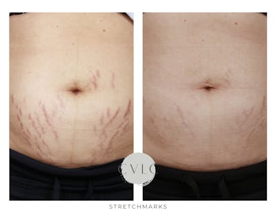 Stretchmarks Before & After Gallery - Patient 256481 - Image 1