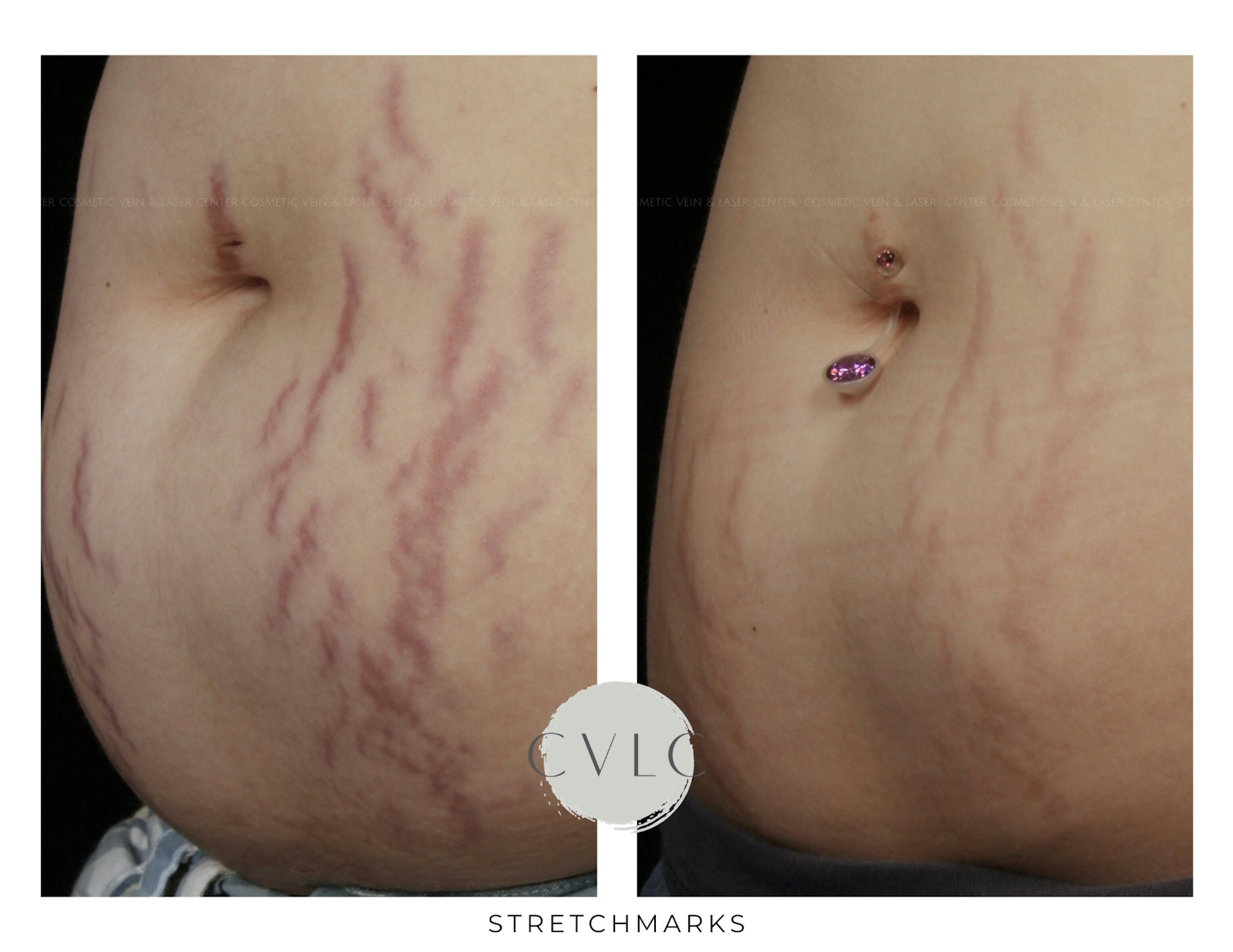 Stretchmarks Before & After Gallery - Patient 326714 - Image 1