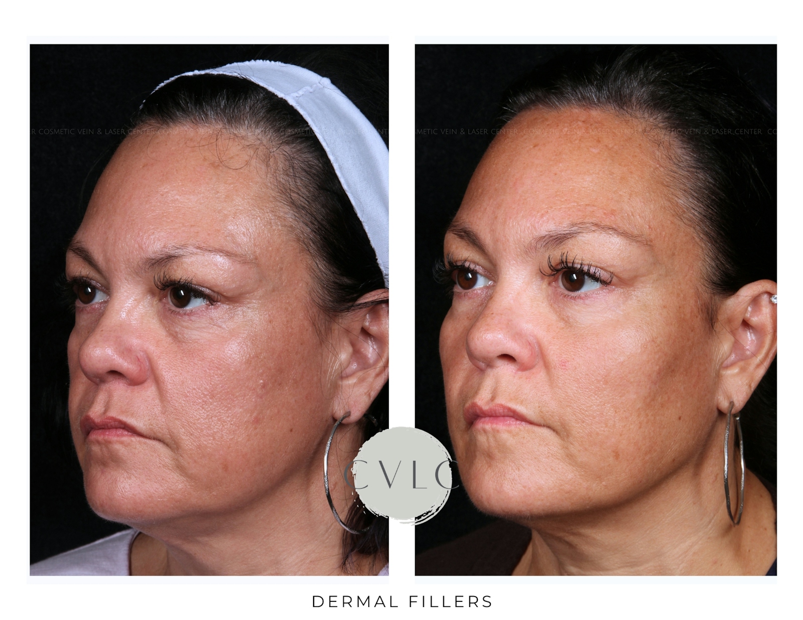 Cosmetic Filler Augmentation Before & After Gallery - Patient 313945 - Image 1
