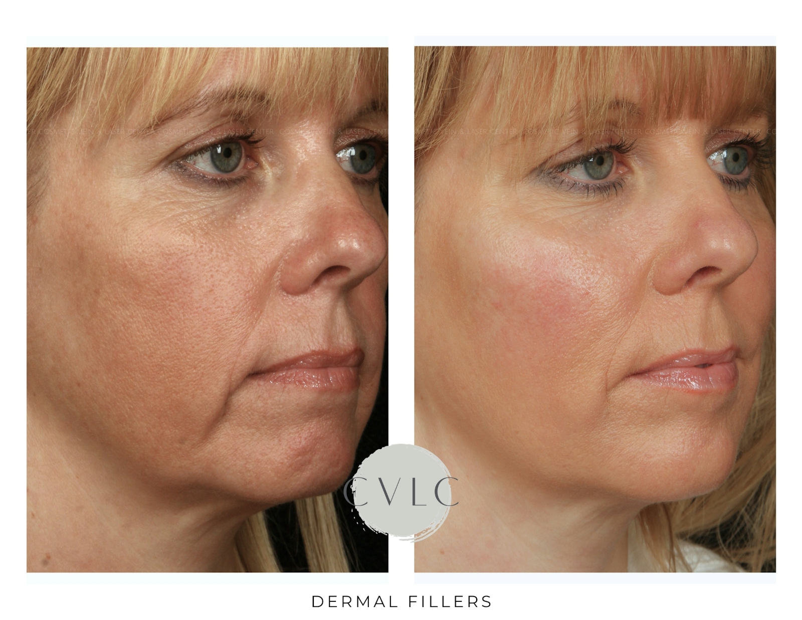Cosmetic Filler Augmentation Before & After Gallery - Patient 142019 - Image 1