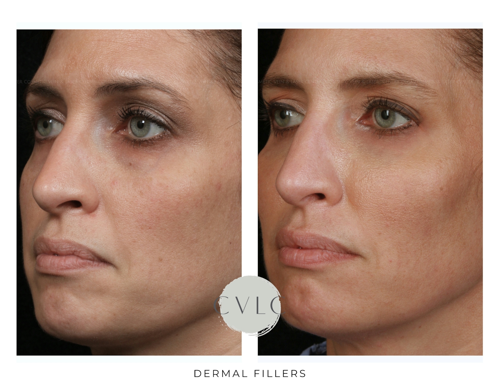 Cosmetic Filler Augmentation Before & After Gallery - Patient 235776 - Image 2