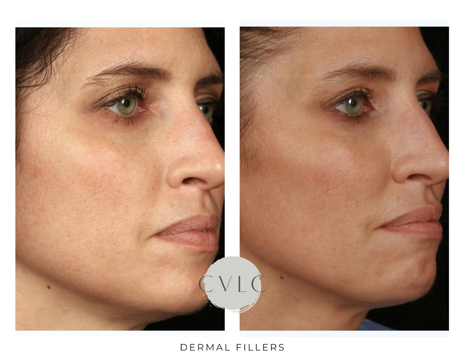 Cosmetic Filler Augmentation Before & After Gallery - Patient 235776 - Image 1