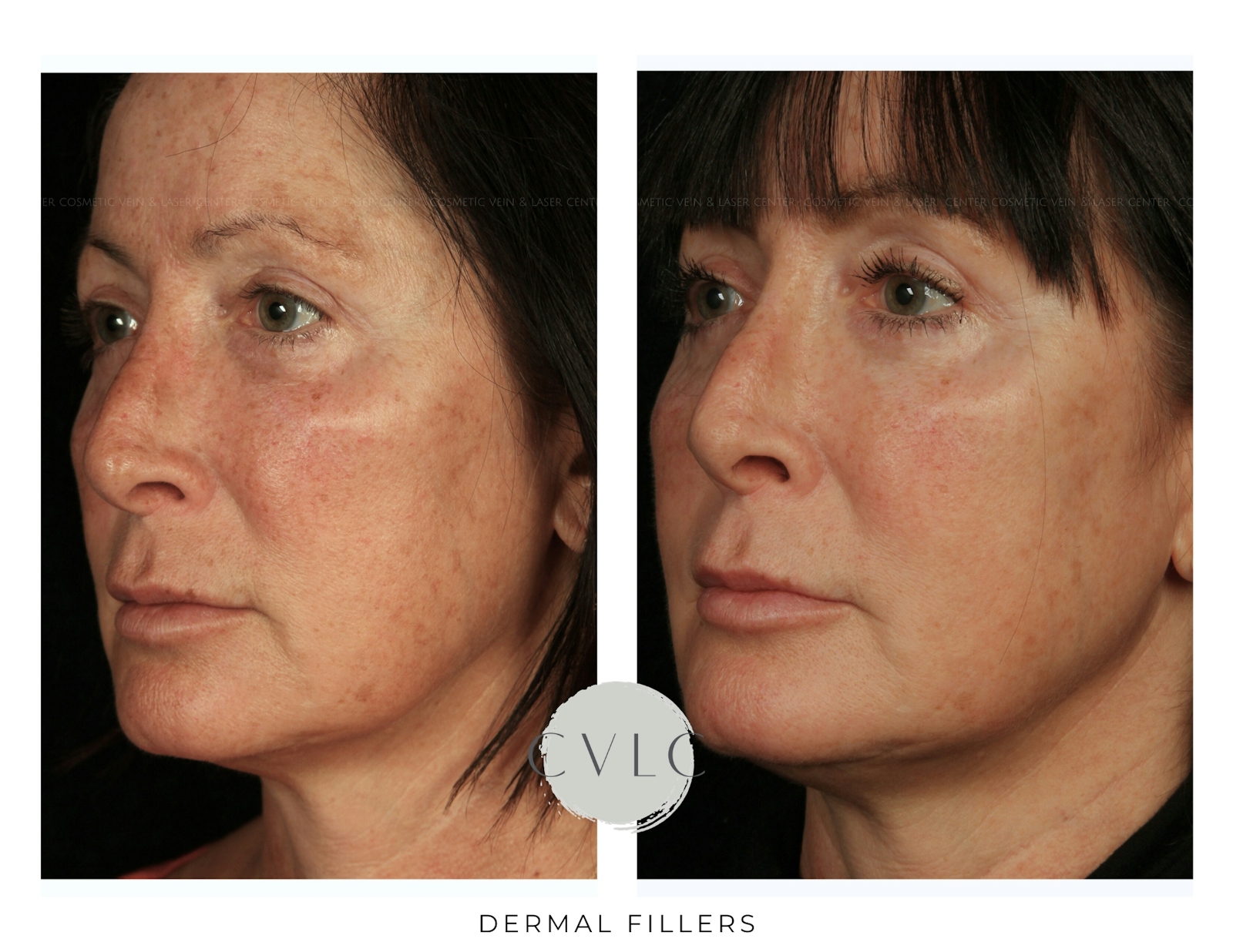 Cosmetic Filler Augmentation Before & After Gallery - Patient 191706 - Image 1