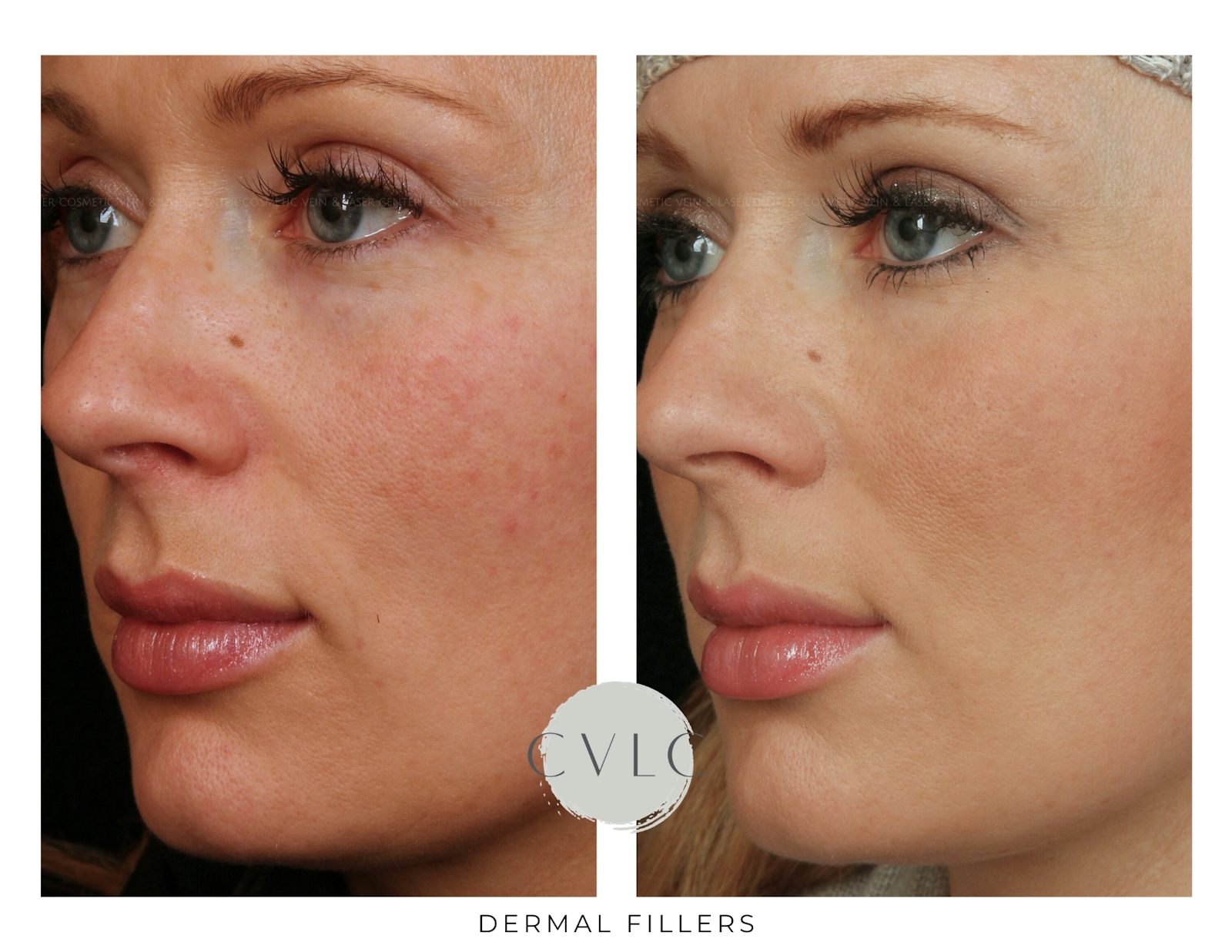 Cosmetic Filler Augmentation Before & After Gallery - Patient 123890 - Image 1