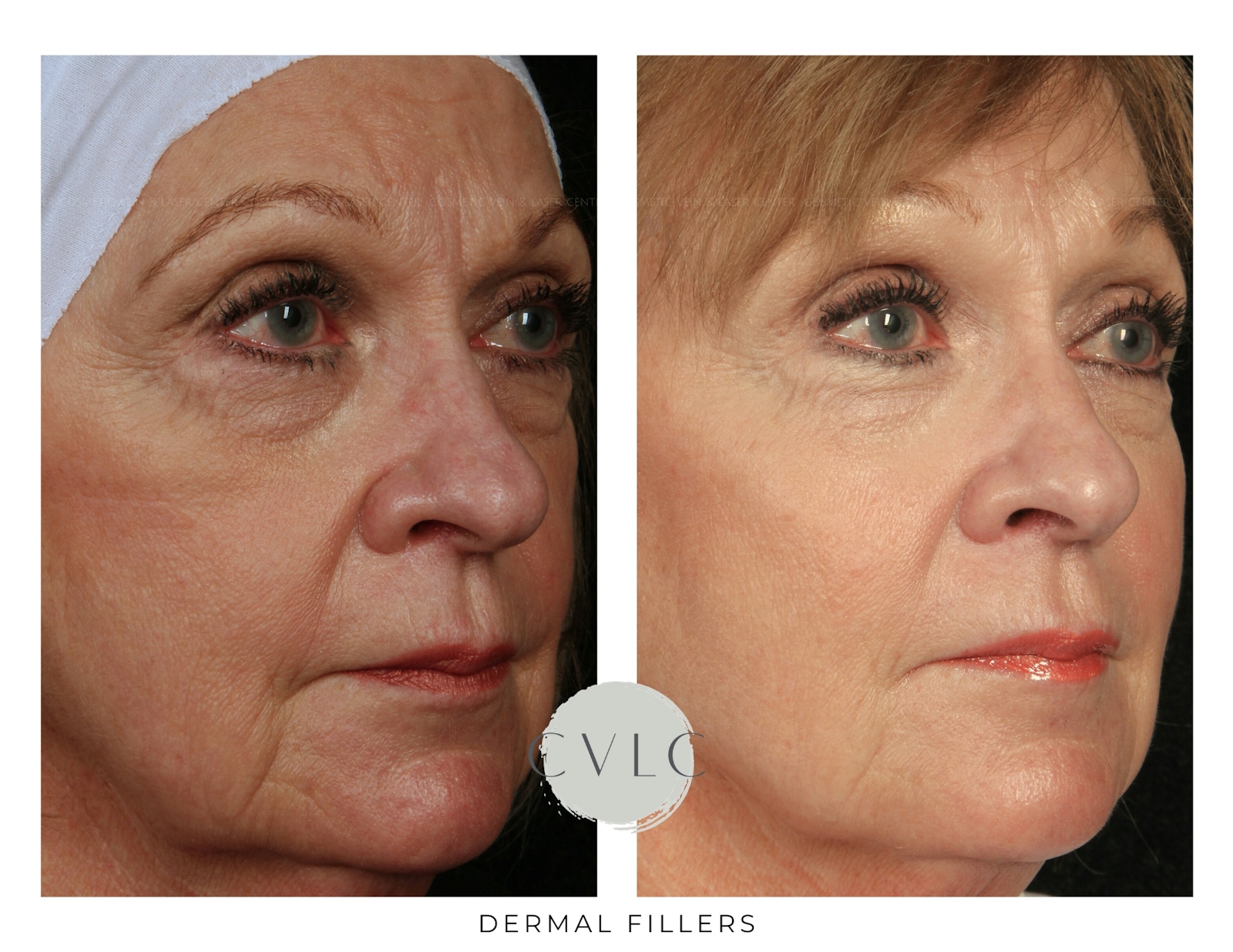 Cosmetic Filler Augmentation Before & After Gallery - Patient 627852 - Image 1