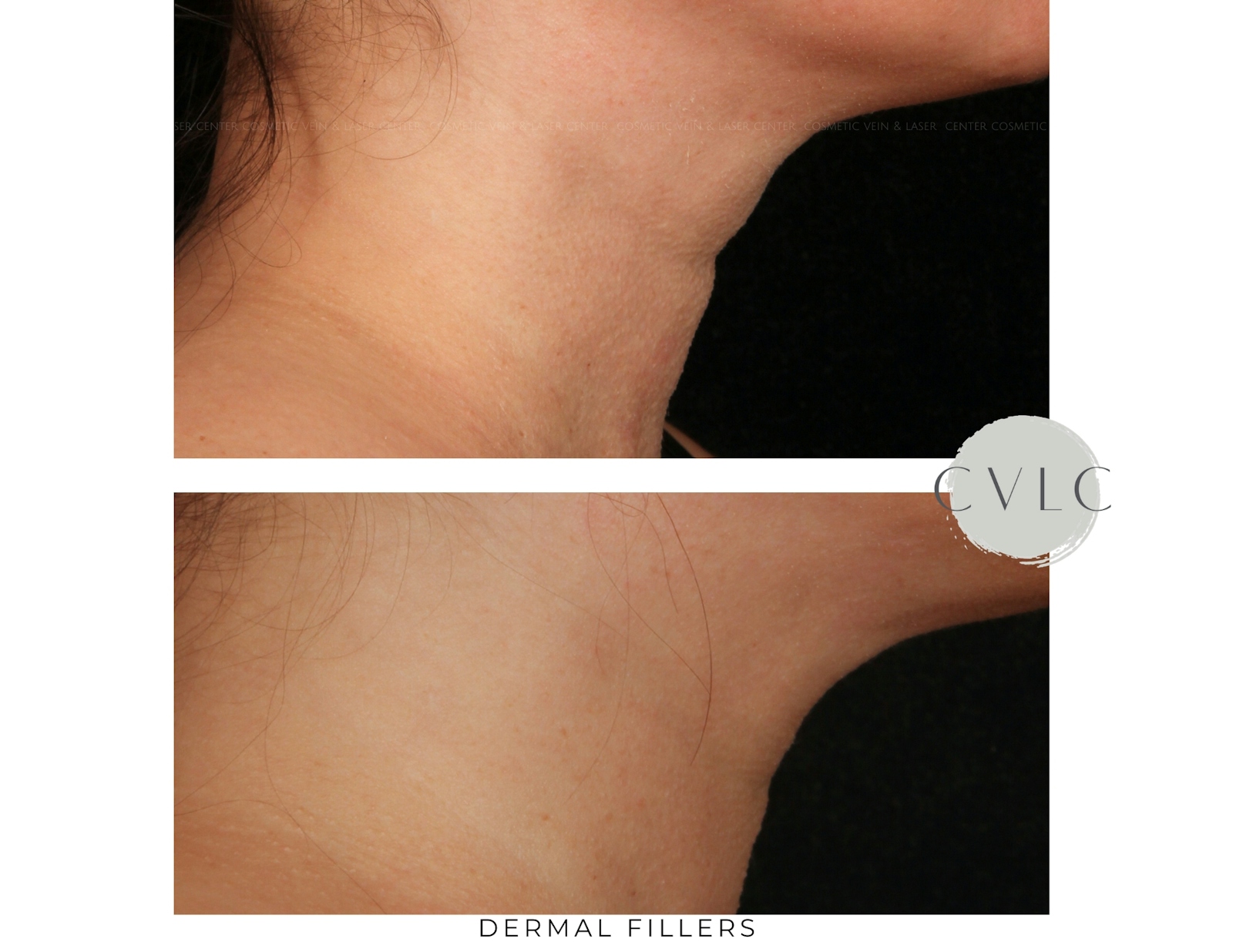 Cosmetic Filler Augmentation Before & After Gallery - Patient 295357 - Image 1