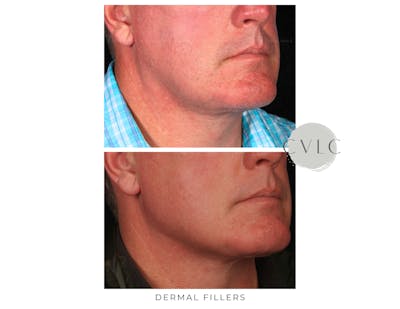 Cosmetic Filler Augmentation Before & After Gallery - Patient 101615 - Image 1