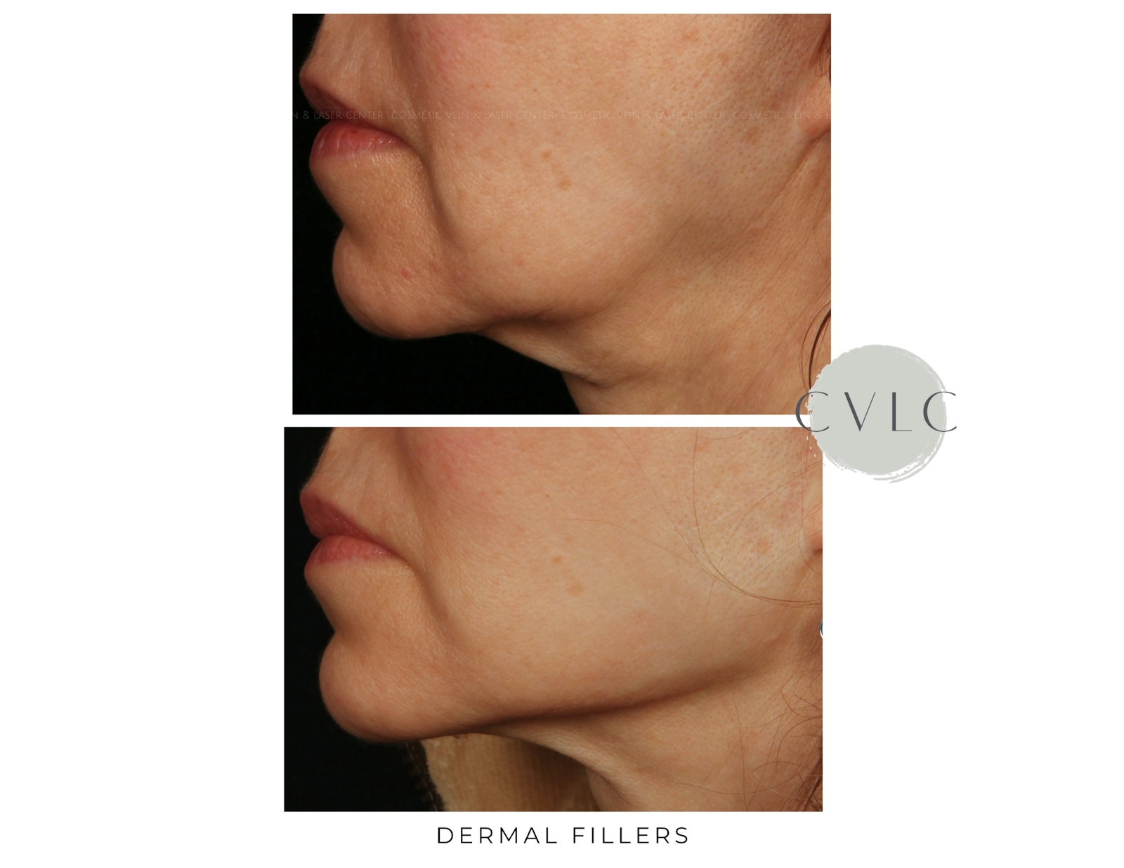 Cosmetic Filler Augmentation Before & After Gallery - Patient 460849 - Image 1
