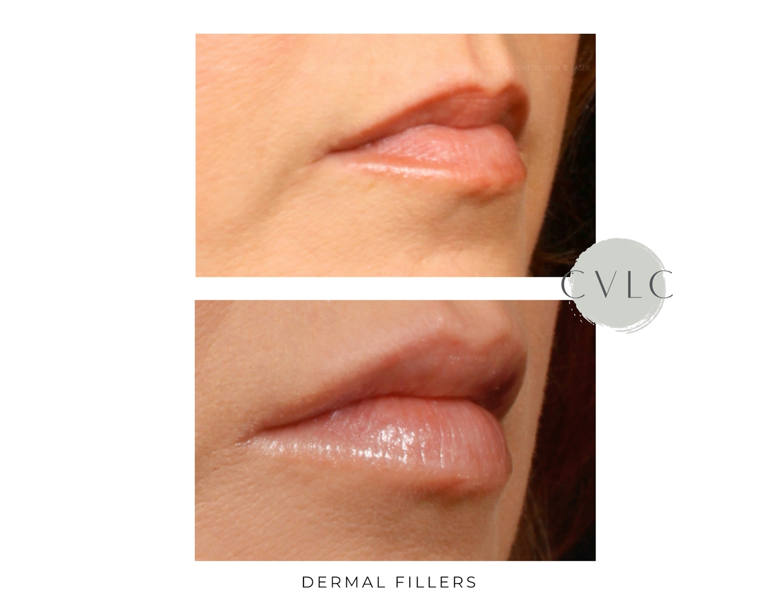 Cosmetic Filler Augmentation Before & After Gallery - Patient 176638 - Image 1