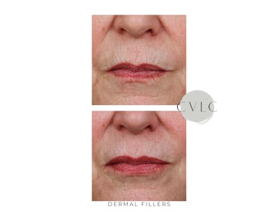 Cosmetic Filler Augmentation Before & After Gallery - Patient 248066 - Image 1