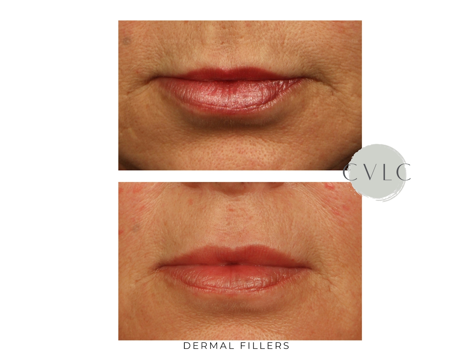 Cosmetic Filler Augmentation Before & After Gallery - Patient 294427 - Image 1