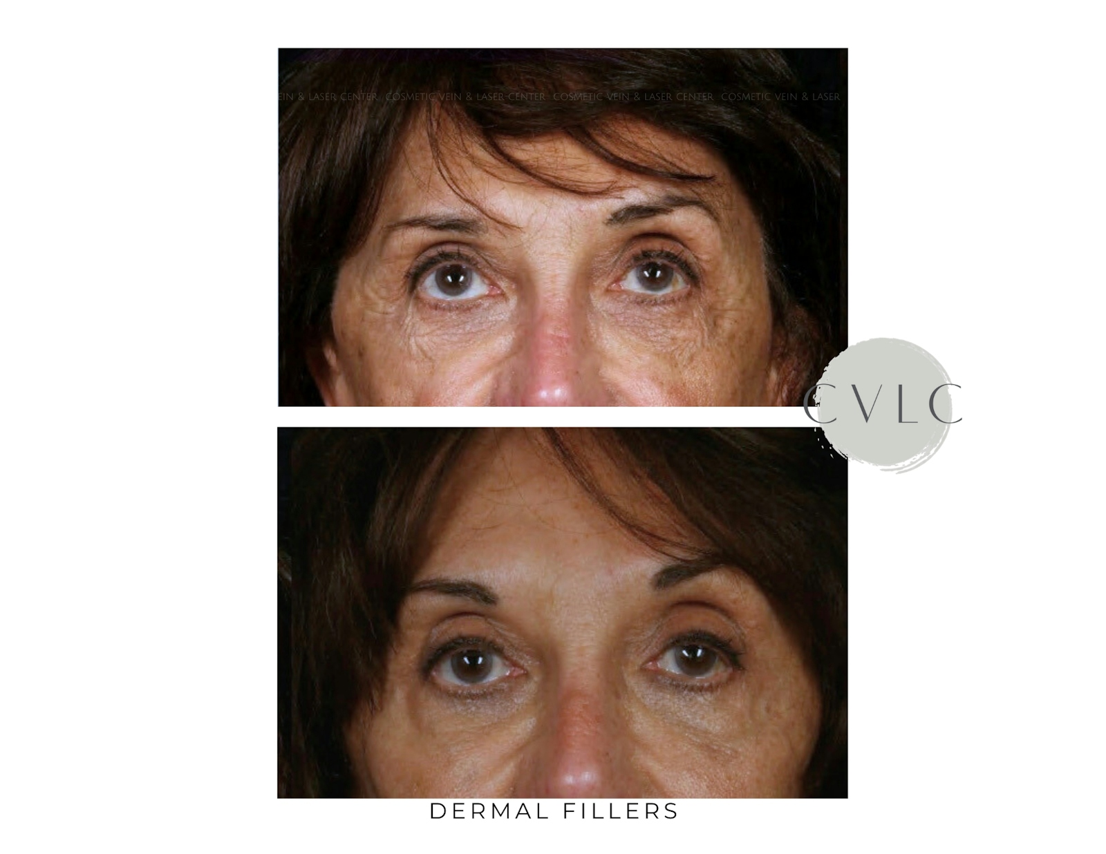 Cosmetic Filler Augmentation Before & After Gallery - Patient 147986 - Image 1