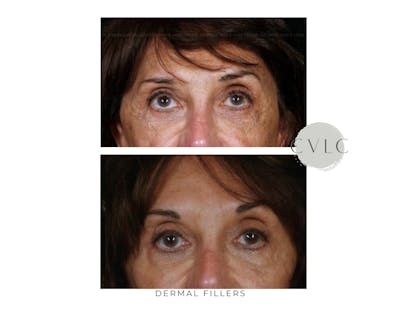 Cosmetic Filler Augmentation Before & After Gallery - Patient 147986 - Image 1