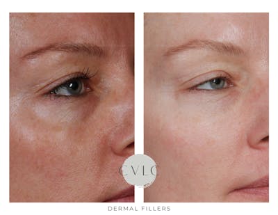 Cosmetic Filler Augmentation Before & After Gallery - Patient 504646 - Image 1