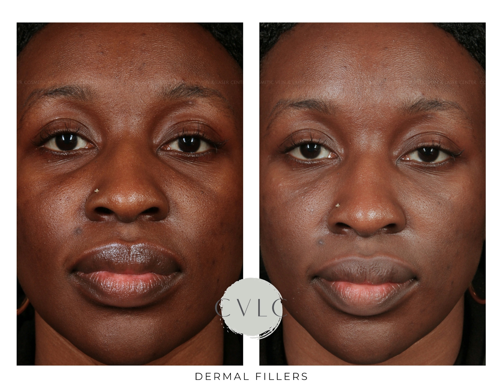 Cosmetic Filler Augmentation Before & After Gallery - Patient 110747 - Image 1