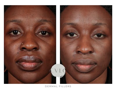 Cosmetic Filler Augmentation Before & After Gallery - Patient 110747 - Image 1