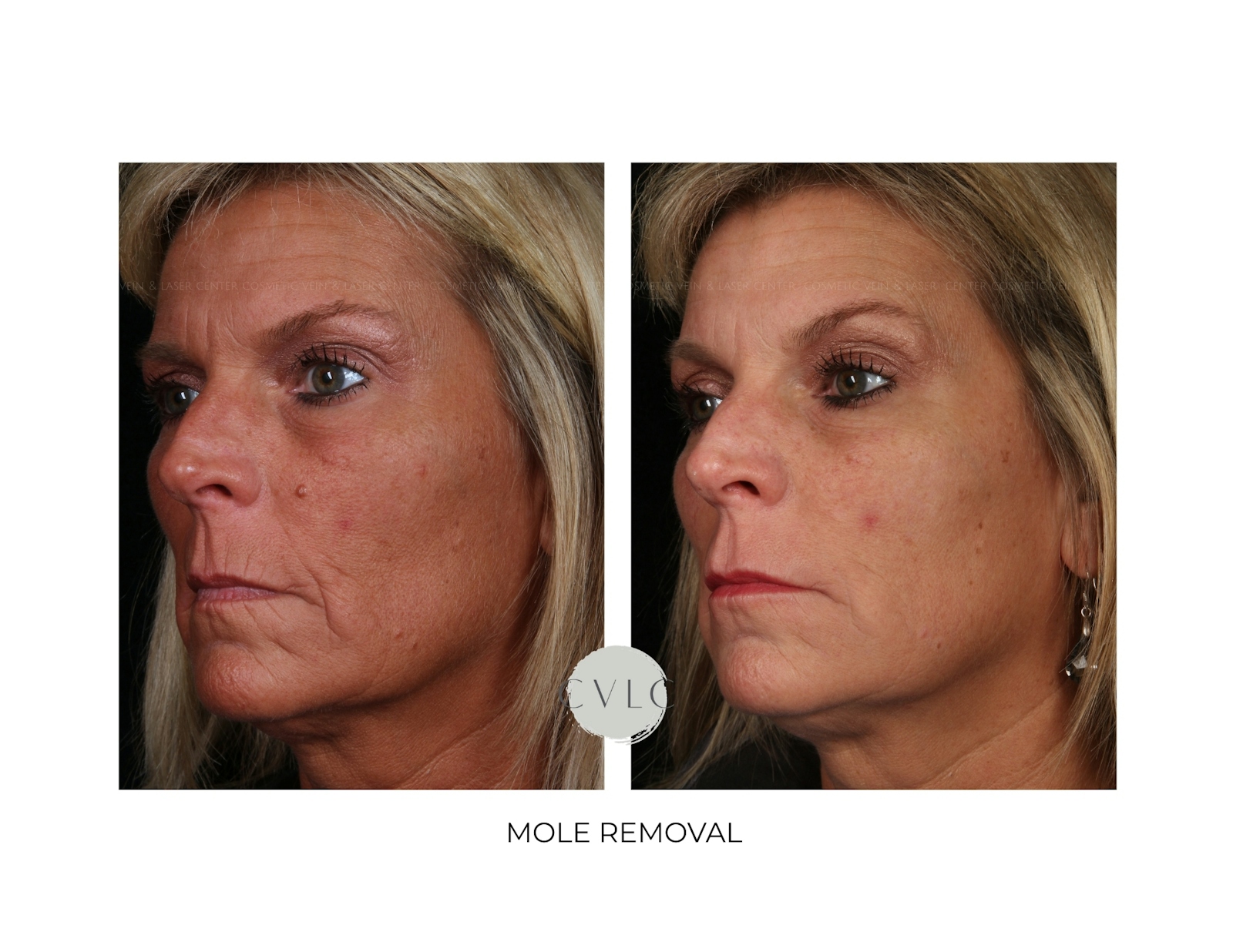 Mole Removal Before & After Gallery - Patient 188824 - Image 1