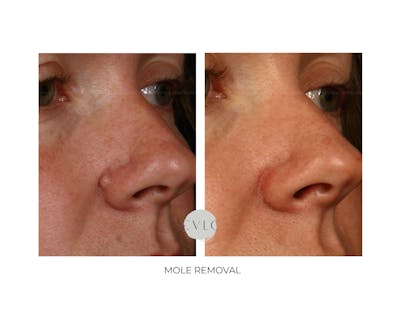Mole Removal Before & After Gallery - Patient 186844 - Image 1